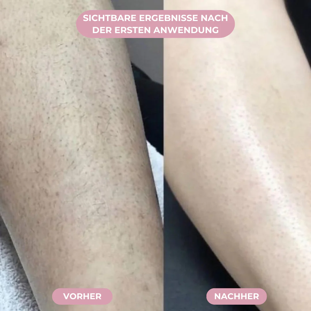 GLIMORA® - IPL Haarentfernung