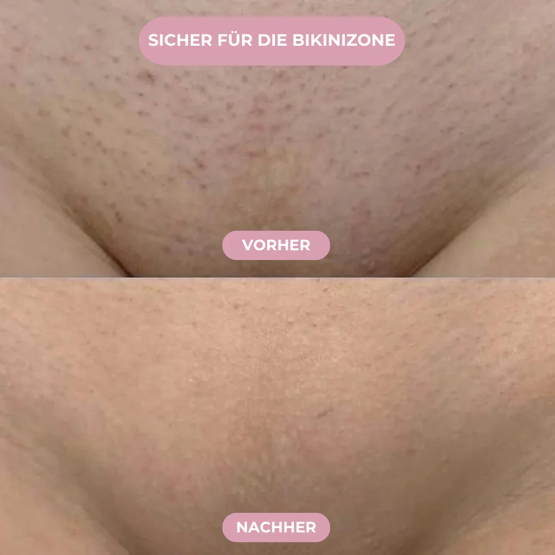 GLIMORA® - IPL Haarentfernung